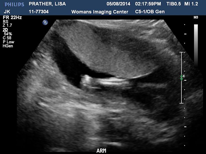 photo Ultrasound-2_zps24fbfb94.jpg