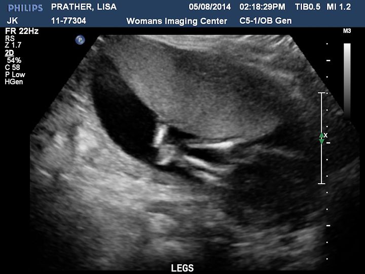  photo Ultrasound-4_zpsafda6022.jpg