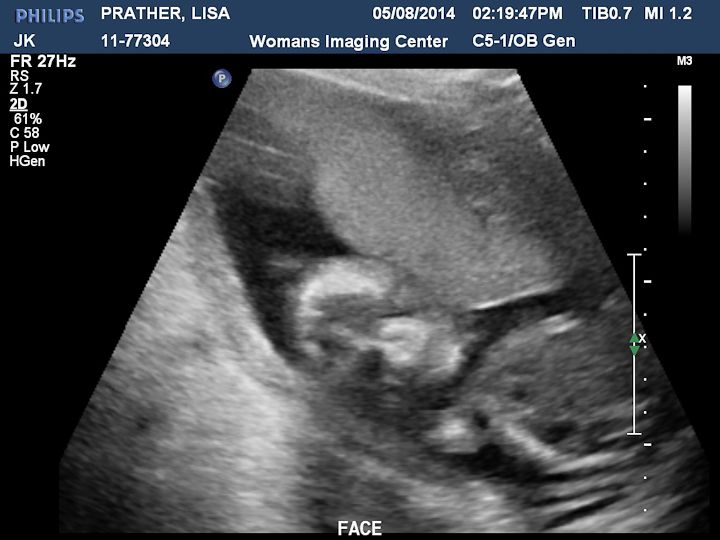  photo Ultrasound-7_zps77e9d72e.jpg
